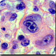 Hodgkin’s Disease Symptoms and Treatment