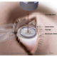 10 Dangers of Lasik Surgery